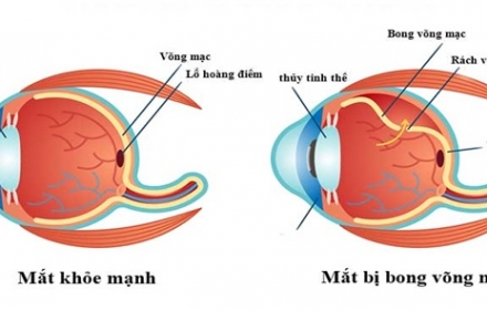 Bong võng mạc
